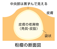 粉瘤の断面図