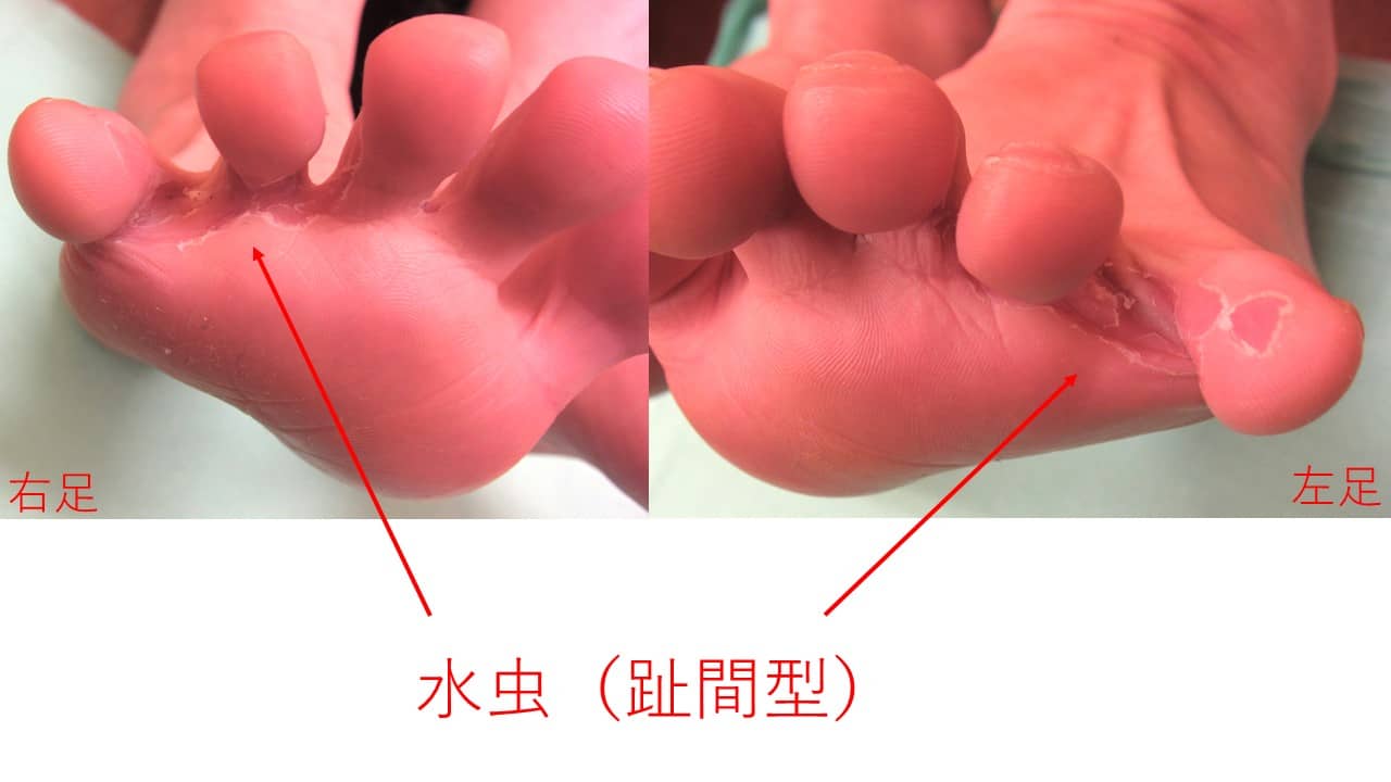 水虫｜やおさか皮フ科クリニック 本郷三丁目 皮膚科 小児皮膚科 アレルギー 文京区