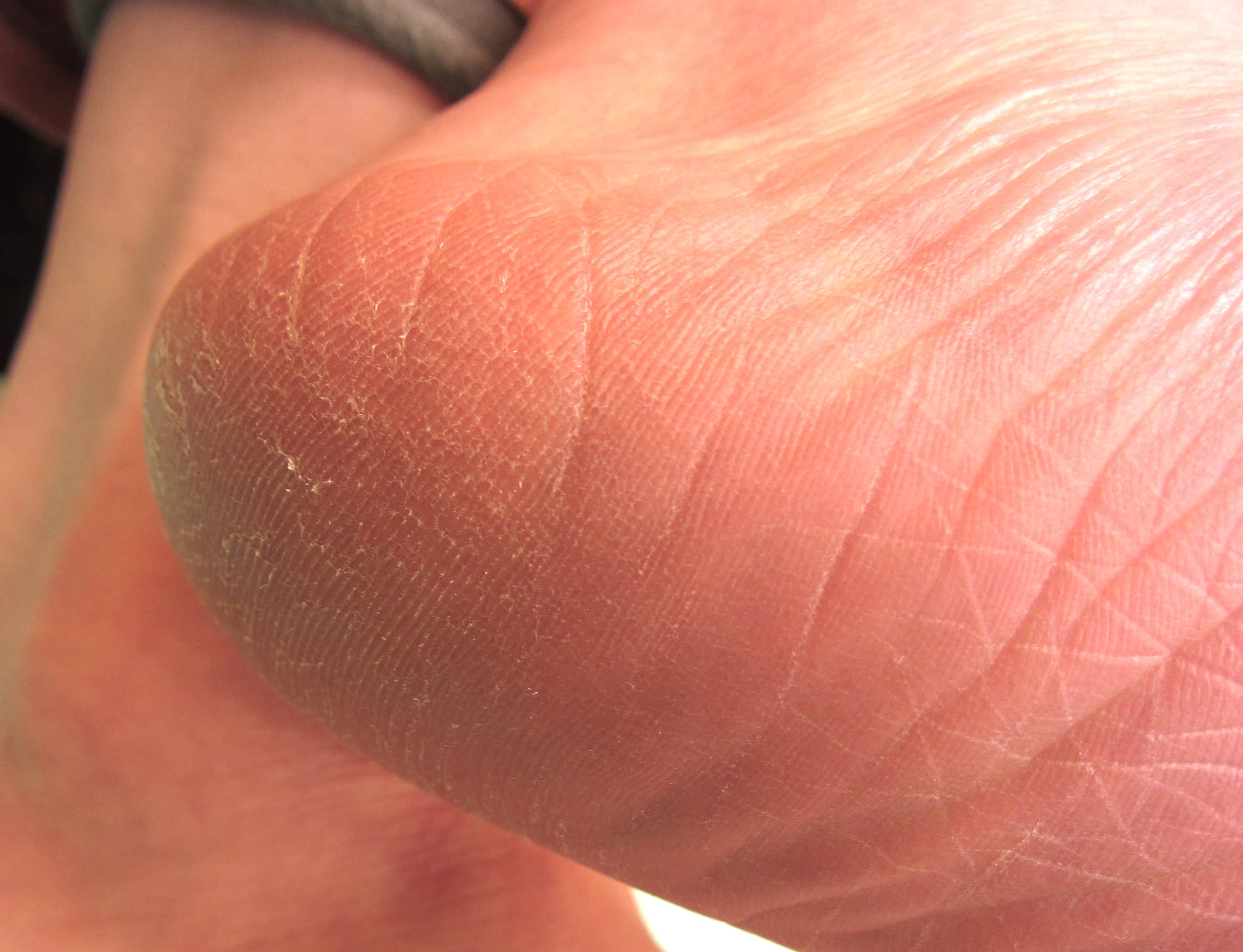 水虫 やおさか皮フ科クリニック 本郷三丁目 皮膚科 小児皮膚科 アレルギー 文京区